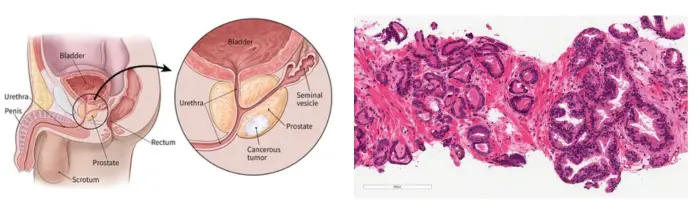 Prostate Cancer Treatment in India