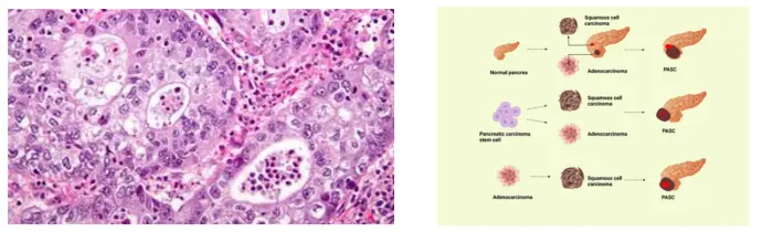 Gallbladder Cancer Treatment in India