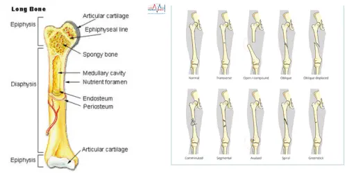 Best Bone Fracture Treatment India