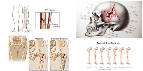 Bone Fracture Treatment In India