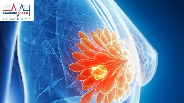 Breast Cancer Treatment in India