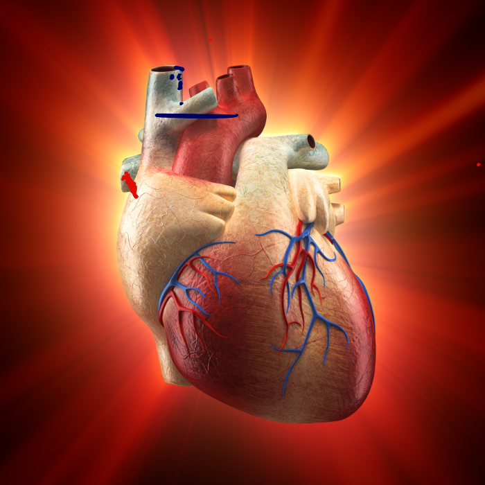 coronary graft