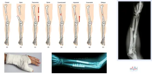 Best Bone Fracture Treatment Cost In India