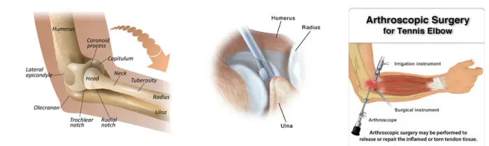 Arthroscopy Surgery In India