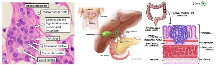 Gallbladder Cancer Treatment in India