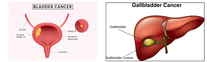 Gallbladder Cancer Treatment in India