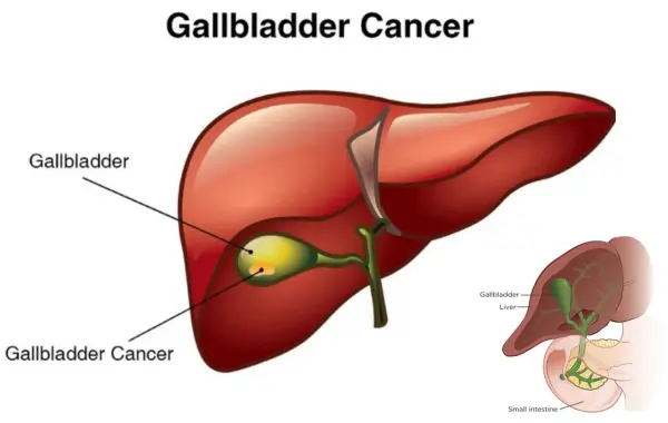 Gallbladder Cancer Treatment in India