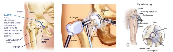 Arthroscopy Surgery In India