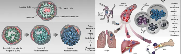 Prostate Cancer Treatment in India