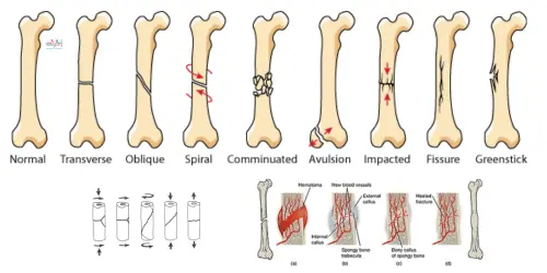 Best Bone Fracture Treatment India