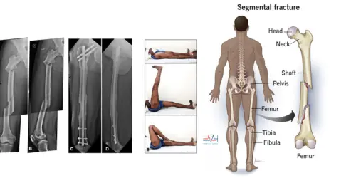 Best Bone Fracture Treatment Cost In India