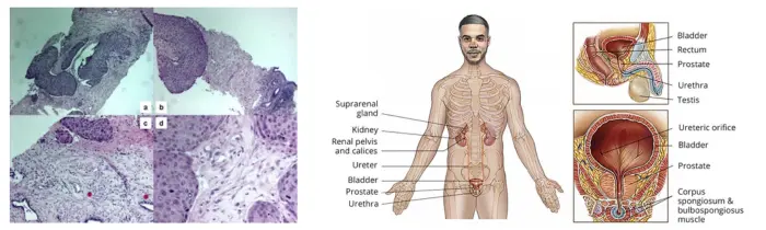 Prostate Cancer Treatment in India