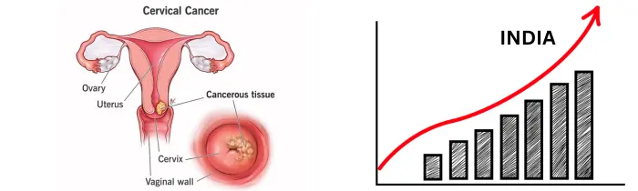 Cervical Cancer Treatment in India