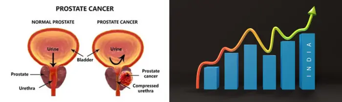 Prostate Cancer Treatment in India