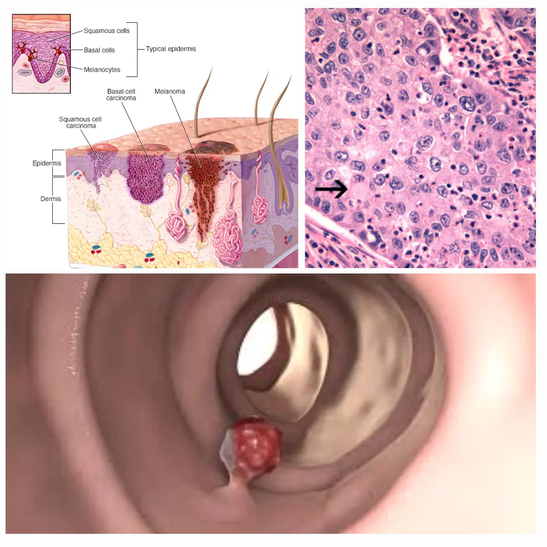 Cervical Cancer Treatment in India